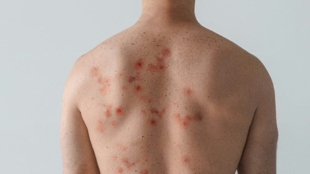 Free vaccine to prevent shingles may lower the risk of dementia